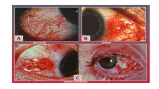 Epiescleritis Escleritis
Escleritis necrotizante
 