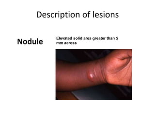 Diffuse Nodular Rash Dermatopathology1 | PPT