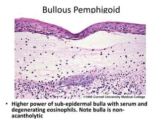 Bullous Process Dermatopathology3 | PPT