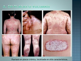 Psoriasis en placas crónica, localizada en sitio característicos.
 