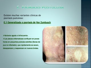 E.1 Generalizada o psoriasis de Von Zumbusch
Variante aguda e infrecuente.
Las placas eritematosas confluyen en pocas
horas en pequeñas pústulas estériles (llenas de
pus no infectado), que rápidamente se secan,
desaparecen y reaparecen en nuevos brotes.
 