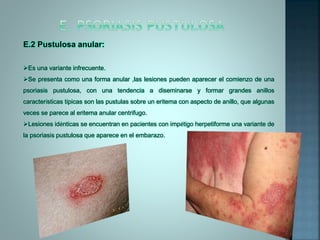 E.2 Pustulosa anular:
Es una variante infrecuente.
Se presenta como una forma anular ,las lesiones pueden aparecer el comienzo de una
psoriasis pustulosa, con una tendencia a diseminarse y formar grandes anillos
características típicas son las pustulas sobre un eritema con aspecto de anillo, que algunas
veces se parece al eritema anular centrifugo.
Lesiones idénticas se encuentran en pacientes con impétigo herpetiforme una variante de
la psoriasis pustulosa que aparece en el embarazo.
 