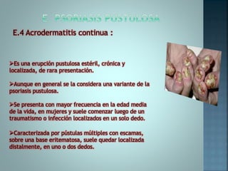 Caracterizada por pústulas múltiples con escamas,
sobre una base eritematosa, suele quedar localizada
distalmente, en uno o dos dedos.
E.4 Acrodermatitis continua :
Es una erupción pustulosa estéril, crónica y
localizada, de rara presentación.
Aunque en general se la considera una variante de la
psoriasis pustulosa.
Se presenta con mayor frecuencia en la edad media
de la vida, en mujeres y suele comenzar luego de un
traumatismo o infección localizados en un solo dedo.
 