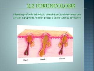 infección profunda del folículo pilosebáceo. Son infecciones que
afectan a grupos de folículos pilosos y tejido cutáneo adyacente
 