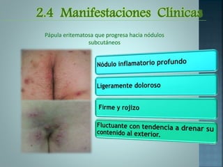 2.4 Manifestaciones Clínicas
Pápula eritematosa que progresa hacia nódulos
subcutáneos
 