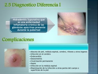 •Absceso de piel, médula espinal, cerebro, riñones u otros órganos
•Infección en el cerebro
•Endocarditis
•Osteomielitis
•Cicatrización permanente
•Sepsis
•Infección en la médula espinal
•Diseminación de la infección a otras partes del cuerpo o
superficies de la piel
2.5 Diagnostico Diferencia l
Hidradenitis Supurativa que
es una enfermedad
inflamatoria crónica de las
glándulas apócrinas presente
durante la pubertad
Complicaciones
 