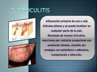 Inflamación primaria de uno o más
folículos pilosos y se puede localizar en
cualquier parte de la piel.
Resultado de trauma (fricción),
reacciones por contacto ocupacional con
sustancias oleosas, oclusión por
vendajes con polietileno o adhesivos,
transpiración o infección.
 