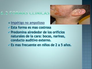  Impétigo no ampolloso
 Esta forma es mas costrosa
 Predomina alrededor de los orificios
naturales de la cara: bocas, narinas,
conducto auditivo externo.
 Es mas frecuente en niños de 2 a 5 años.
 