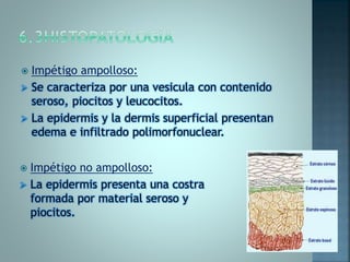  Impétigo ampolloso:
 Se caracteriza por una vesicula con contenido
seroso, piocitos y leucocitos.
 La epidermis y la dermis superficial presentan
edema e infiltrado polimorfonuclear.
 Impétigo no ampolloso:
 La epidermis presenta una costra
formada por material seroso y
piocitos.
 