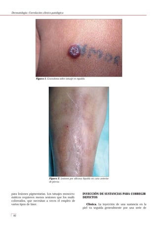 Piyoderma Dermatopatología correlación clínico patológica | PDF