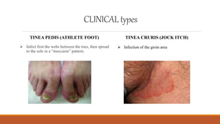 Moccasin Pattern Tinea Dermatophytes | PPTX