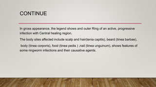 CONTINUE
In gross appearance, the legend shows and outer Ring of an active, progressive
infection with Central healing region.
The body sites affected include scalp and hair(tenia capitis), beard (tinea barbae),
body (tinea corporis), food (tinea pedis ) ,nail (tinea unguinum), shows features of
some ringworm infections and their causative agents.
 