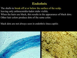 dermatophytosis .ppt