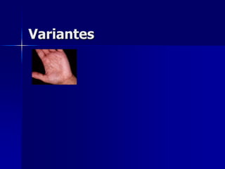 Variantes
 