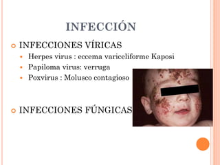 CRITERIOS DE DERIVACIÓN
 URGENTE:
 Sospecha de eczema herpético variceliforme de Kaposi.
 PREFERENTE:
 Brote severo si...