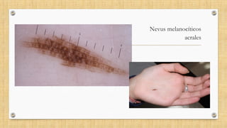 Nevus melanocíticos
acrales
 
