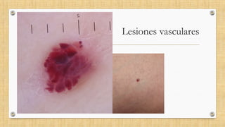 Lesiones vasculares
 