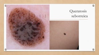 Queratosis
seborreica
 