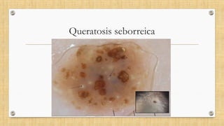 Queratosis seborreica
 