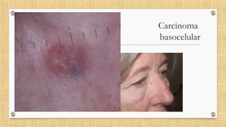 Carcinoma
basocelular
 