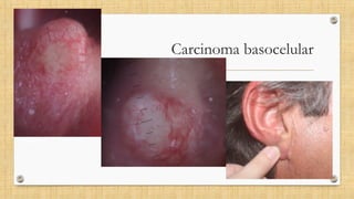Carcinoma basocelular
 
