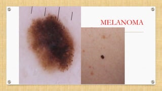 MELANOMA
 