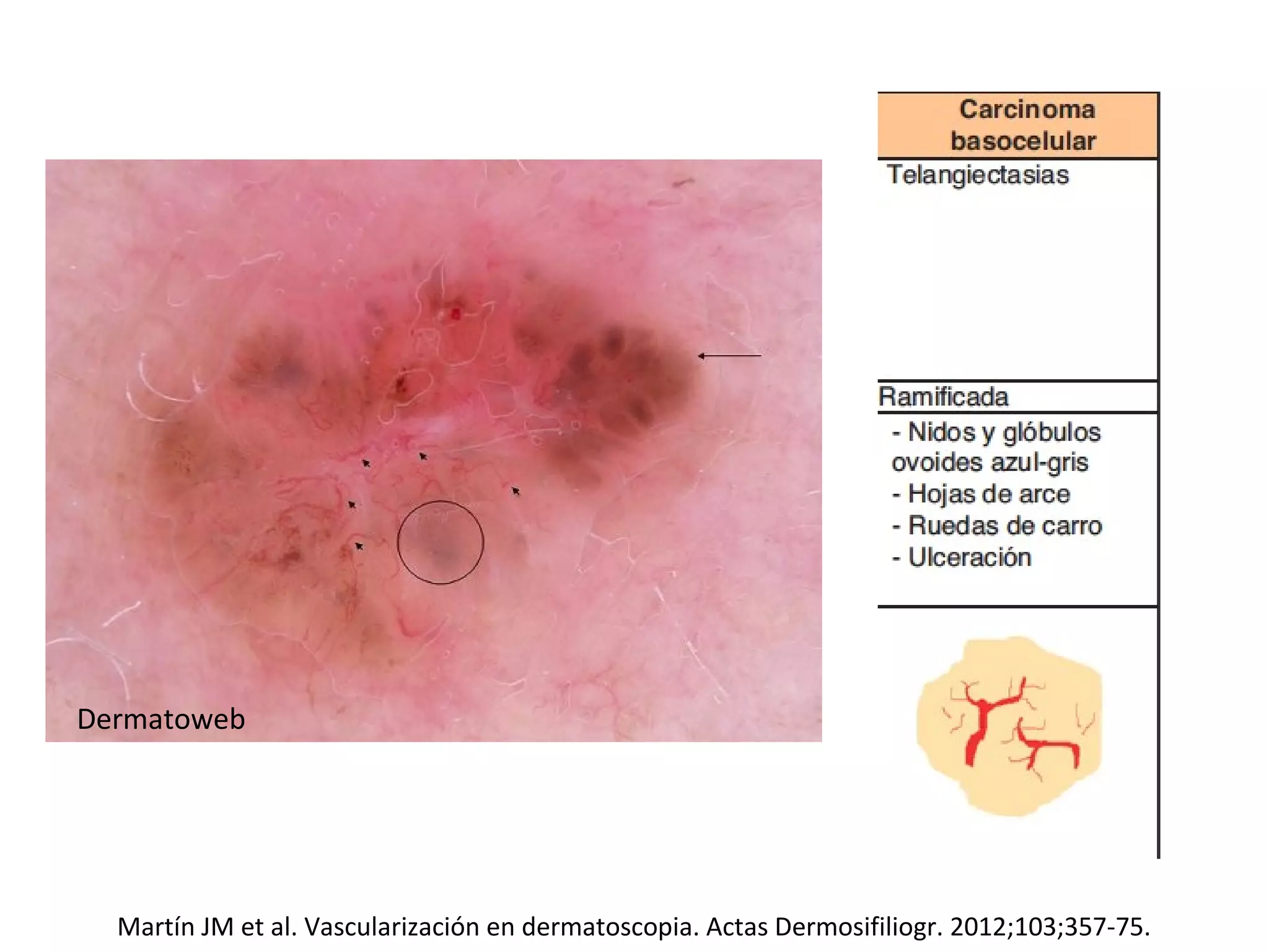 Dermatoscopia En Atenci n Primaria PPT dermatoscopia-en-atenci-n-primaria-ppt