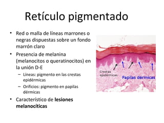 Retículo pigmentado
• Red o malla de líneas marrones o
negras dispuestas sobre un fondo
marrón claro
• Presencia de melanina
(melanocitos o queratinocitos) en
la unión D-E
– Líneas: pigmento en las crestas
epidérmicas
– Orificios: pigmento en papilas
dérmicas
• Característico de lesiones
melanocíticas
 