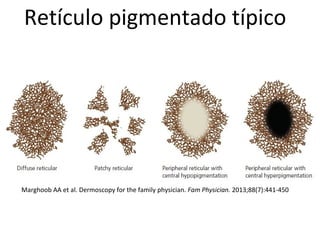 Retículo pigmentado típico
Marghoob AA et al. Dermoscopy for the family physician. Fam Physician. 2013;88(7):441-450
 