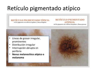 Retículo pigmentado atípico
• Líneas de grosor irregular,
prominentes
• Distribución irregular
• Interrupción abrupta en
periferia
• Nevus melanocítico atípico o
melanoma
 