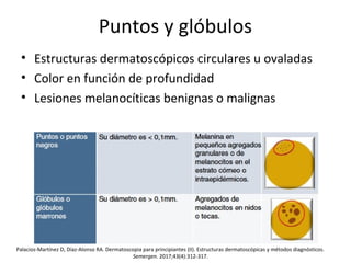 Puntos y glóbulos
• Estructuras dermatoscópicos circulares u ovaladas
• Color en función de profundidad
• Lesiones melanocíticas benignas o malignas
Palacios-Martínez D, Díaz-Alonso RA. Dermatoscopia para principiantes (II). Estructuras dermatoscópicas y métodos diagnósticos.
Semergen. 2017;43(4):312-317.
 