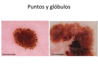 Puntos y glóbulos
Dermatoweb Dermatoweb
 