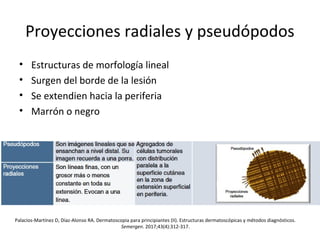Proyecciones radiales y pseudópodos
• Estructuras de morfología lineal
• Surgen del borde de la lesión
• Se extendien hacia la periferia
• Marrón o negro
Palacios-Martínez D, Díaz-Alonso RA. Dermatoscopia para principiantes (II). Estructuras dermatoscópicas y métodos diagnósticos.
Semergen. 2017;43(4):312-317.
 