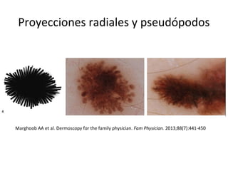 Proyecciones radiales y pseudópodos
Marghoob AA et al. Dermoscopy for the family physician. Fam Physician. 2013;88(7):441-450
 