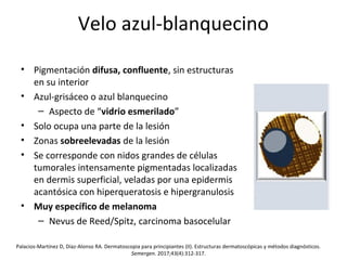 Velo azul-blanquecino
• Pigmentación difusa, confluente, sin estructuras
en su interior
• Azul-grisáceo o azul blanquecino
– Aspecto de “vidrio esmerilado”
• Solo ocupa una parte de la lesión
• Zonas sobreelevadas de la lesión
• Se corresponde con nidos grandes de células
tumorales intensamente pigmentadas localizadas
en dermis superficial, veladas por una epidermis
acantósica con hiperqueratosis e hipergranulosis
• Muy específico de melanoma
– Nevus de Reed/Spitz, carcinoma basocelular
Palacios-Martínez D, Díaz-Alonso RA. Dermatoscopia para principiantes (II). Estructuras dermatoscópicas y métodos diagnósticos.
Semergen. 2017;43(4):312-317.
 