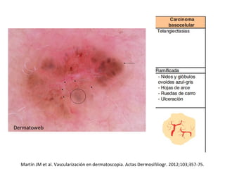 Martín JM et al. Vascularización en dermatoscopia. Actas Dermosifiliogr. 2012;103;357-75.
Dermatoweb
 