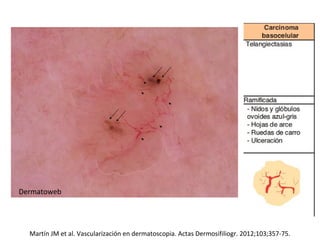 Martín JM et al. Vascularización en dermatoscopia. Actas Dermosifiliogr. 2012;103;357-75.
Dermatoweb
 