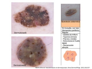 Martín JM et al. Vascularización en dermatoscopia. Actas Dermosifiliogr. 2012;103;357-
Dermatoweb
Dermatoweb
 
