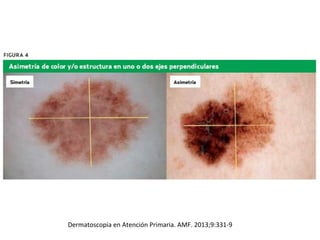 Dermatoscopia en Atención Primaria. AMF. 2013;9:331-9
 