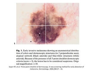 Soyer HP, et al. Three-point checklist of dermoscopy. A new screening method for early detection of
melanoma. Dermatology. 2004;208:27---31.
 