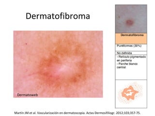 Dermatofibroma
Martín JM et al. Vascularización en dermatoscopia. Actas Dermosifiliogr. 2012;103;357-75.
Dermatoweb
 