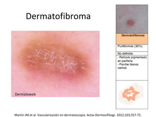 Dermatofibroma
Martín JM et al. Vascularización en dermatoscopia. Actas Dermosifiliogr. 2012;103;357-75.
Dermatoweb
 