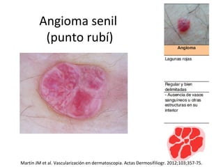 Angioma senil
(punto rubí)
Martín JM et al. Vascularización en dermatoscopia. Actas Dermosifiliogr. 2012;103;357-75.
 