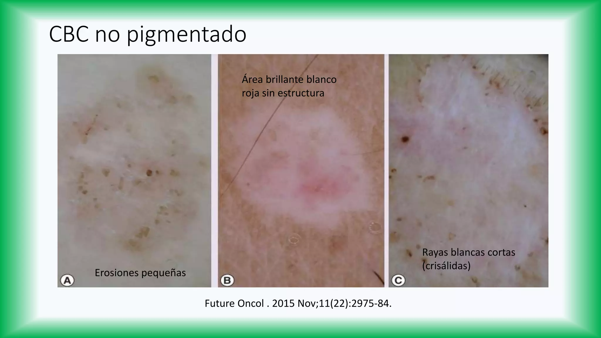 Dermatoscopía del Carcinoma Basocelular | PPTX | Skin and Dermatology ...