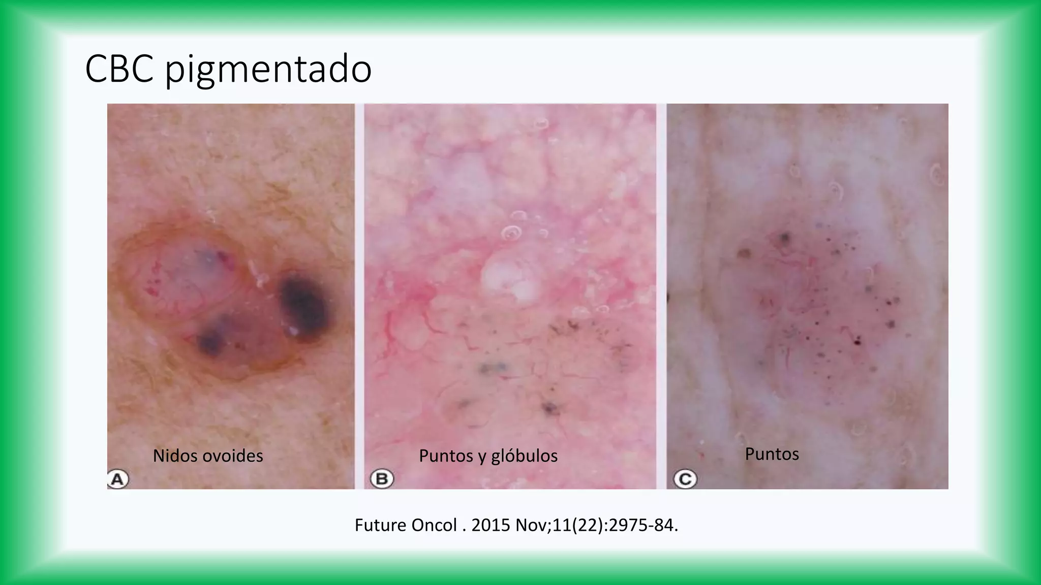 Dermatoscopía del Carcinoma Basocelular | PPTX | Skin and Dermatology ...