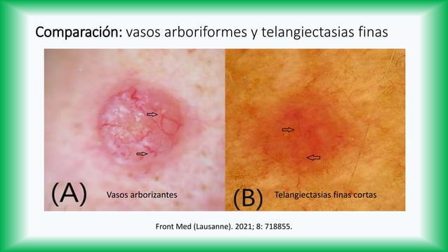 Dermatoscopía del Carcinoma Basocelular | PPTX | Skin and Dermatology ...