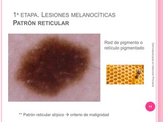 1ª ETAPA. LESIONES MELANOCÍTICAS
PATRÓN RETICULAR
11
DermatoscopiaenAtenciónPrimaria
Red de pigmento o
retículo pigmentado...