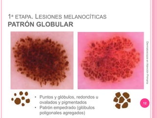1ª ETAPA. LESIONES MELANOCÍTICAS
PATRÓN GLOBULAR
12
DermatoscopiaenAtenciónPrimaria
• Puntos y glóbulos, redondos u
ovala...