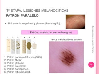 1ª ETAPA. LESIONES MELANOCÍTICAS
PATRÓN PARALELO
15
DermatoscopiaenAtenciónPrimaria
• Únicamente en palmas y plantas (derm...