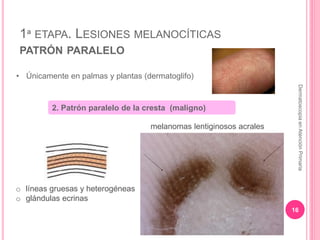 1ª ETAPA. LESIONES MELANOCÍTICAS
PATRÓN PARALELO
16
DermatoscopiaenAtenciónPrimaria
• Únicamente en palmas y plantas (derm...